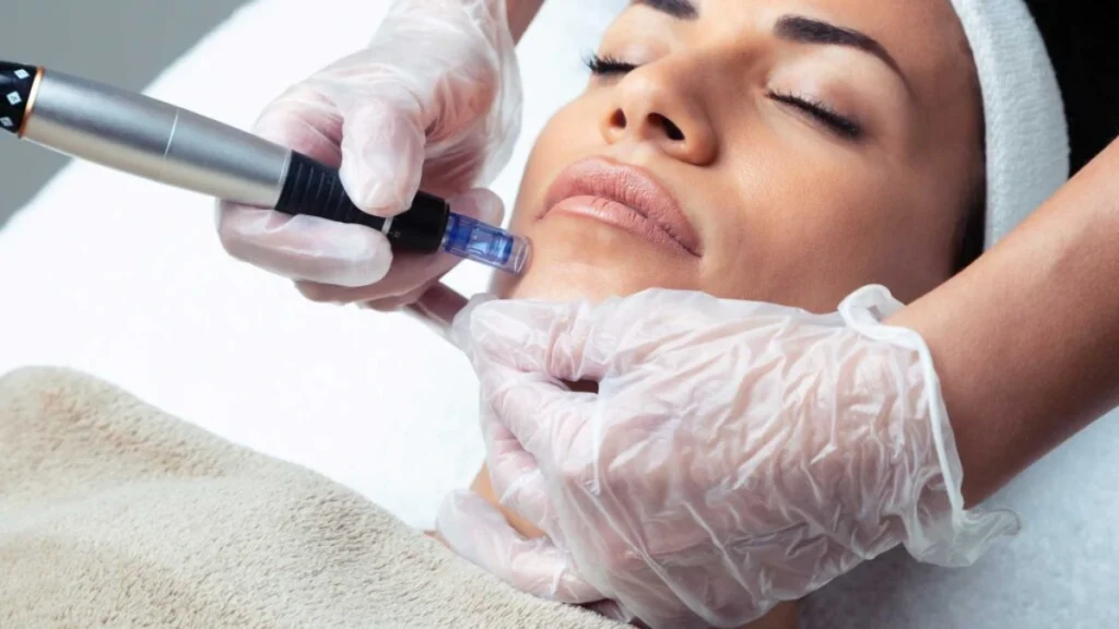 Woman receiving Microneedling facial treatment in George, UT | MaVie Med Spa
