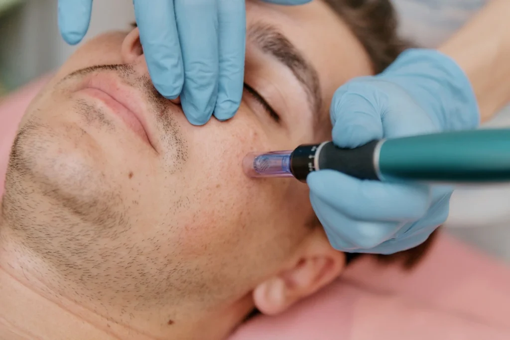 Man receiving microneedling treatment in George UT | MaVie Med Spa