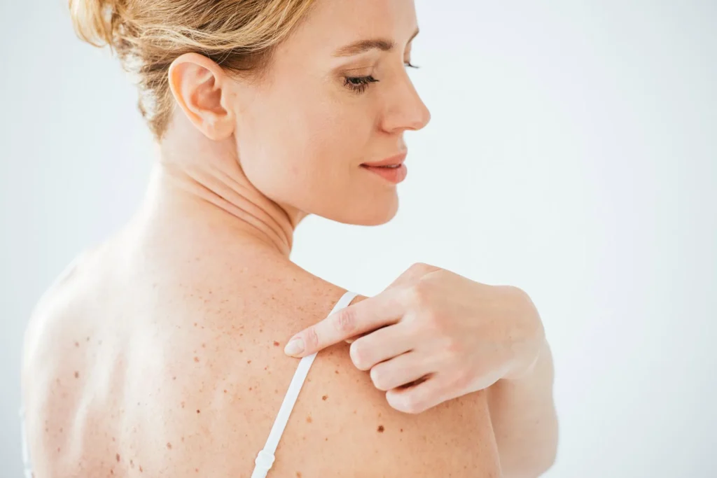 Skin Tag & Mole Removal in George UT at MaVie Med Spa