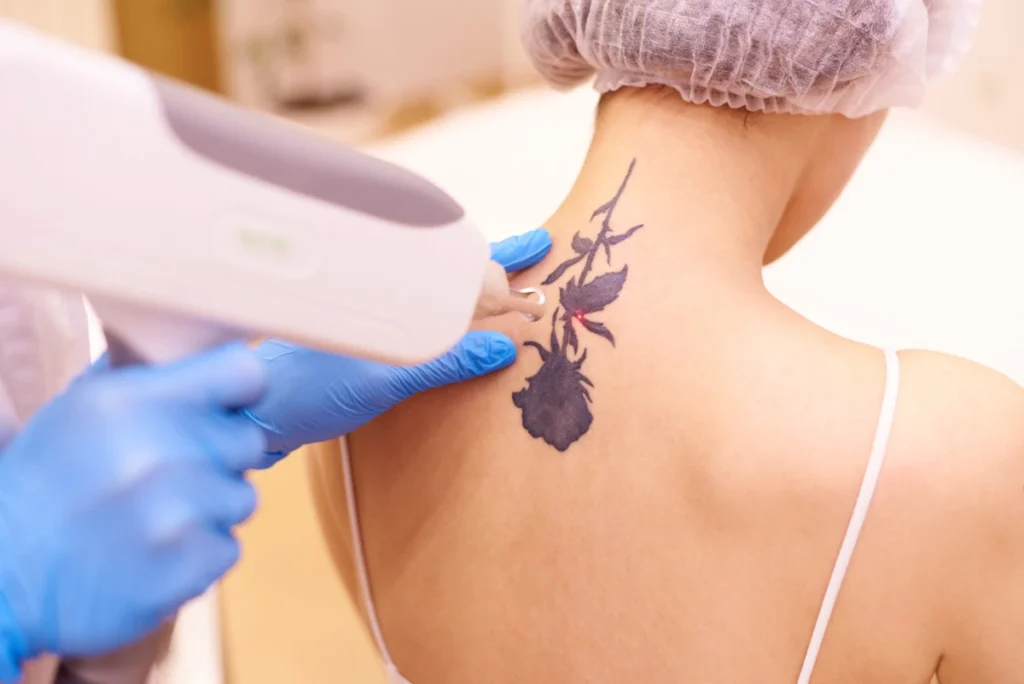 Tattoo-Removal-by-MaVie-Med-Spa-in-George-UT