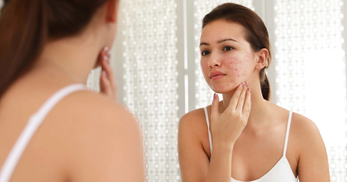 Young woman looking sad at her acne-prone skin before treatment, highlighting the need for Facials in St. George, UT.