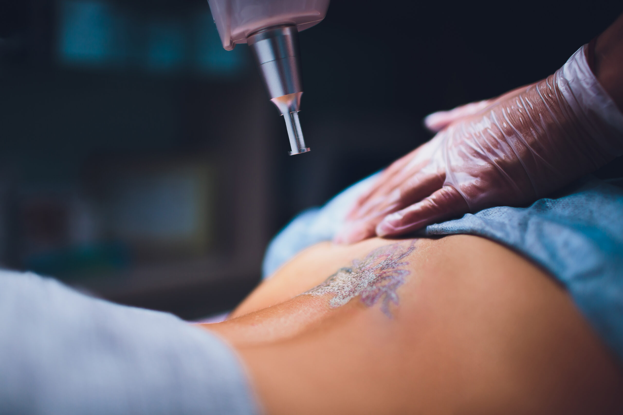 How Many Sessions Does Laser Tattoo Removal Take? | Mavie Med Spa in St. George, UT