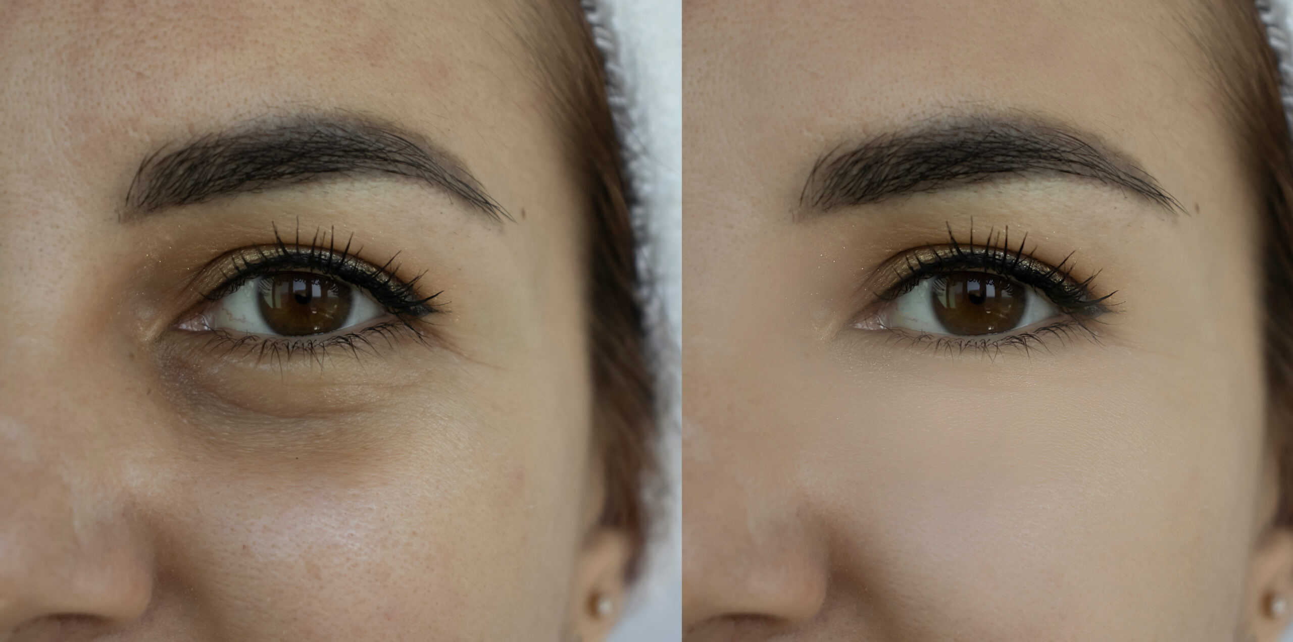 Why Sculptra Is Gaining Popularity in the Anti-Aging Market | Mavie Medspa in St. George, UT