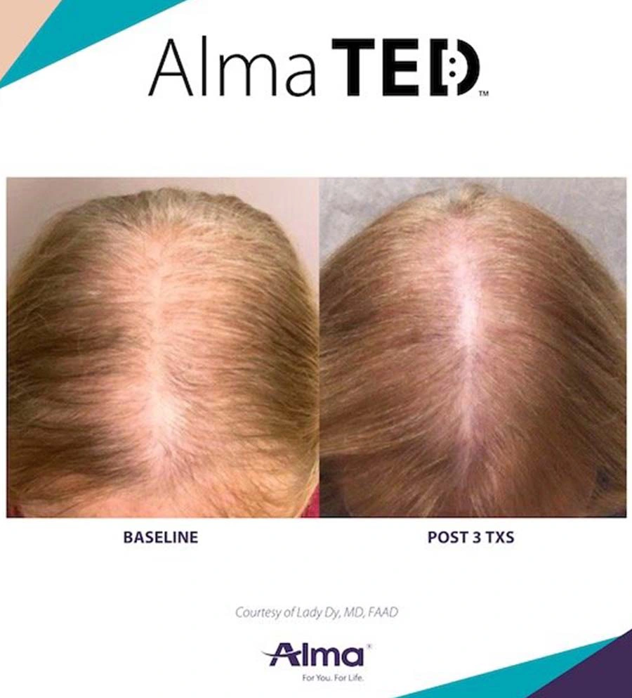 almated-hair-restoration-by-MaVie-Med-Spa-in-George-UT