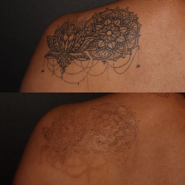 Tattoo Removal Treatment in George UT at MaVie Med Spa