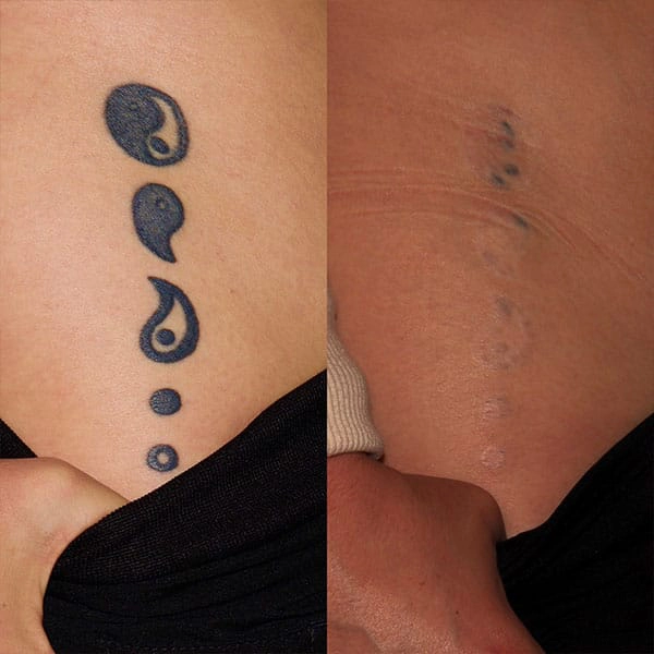Tattoo Removal Treatment in George UT at MaVie Med Spa