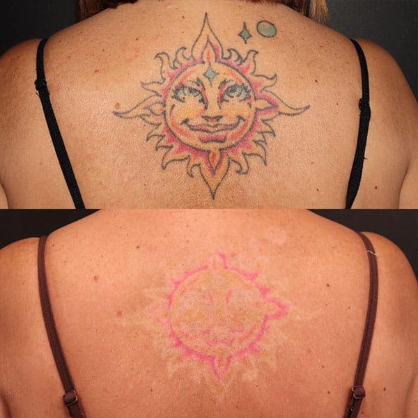 Tattoo Removal Treatment in George UT at MaVie Med Spa