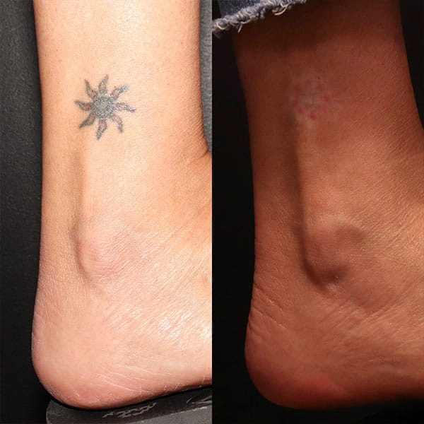 Tattoo Removal Treatment in George UT at MaVie Med Spa