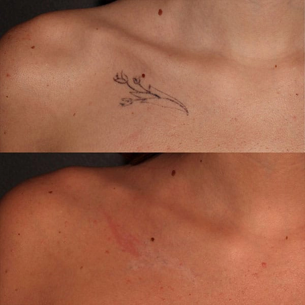 Tattoo Removal Treatment in George UT at MaVie Med Spa